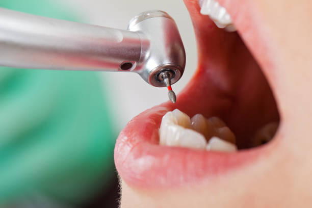 Best Emergency Dental Care for Broken or Chipped Teeth in Fayette, OH